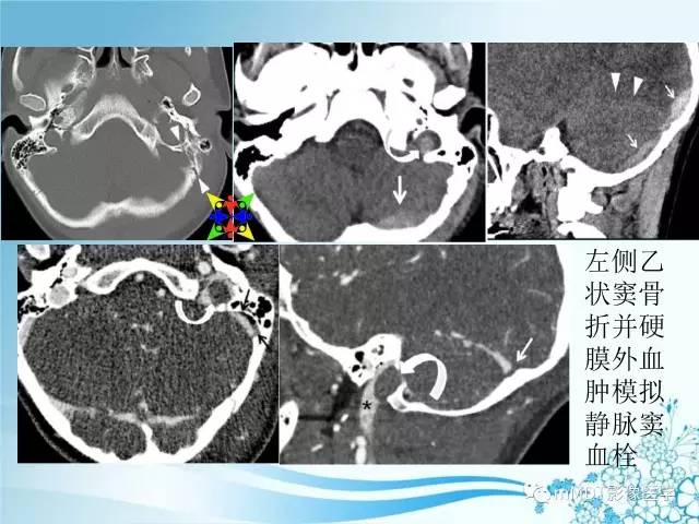 【PPT】脑静脉及静脉窦血栓影像诊断