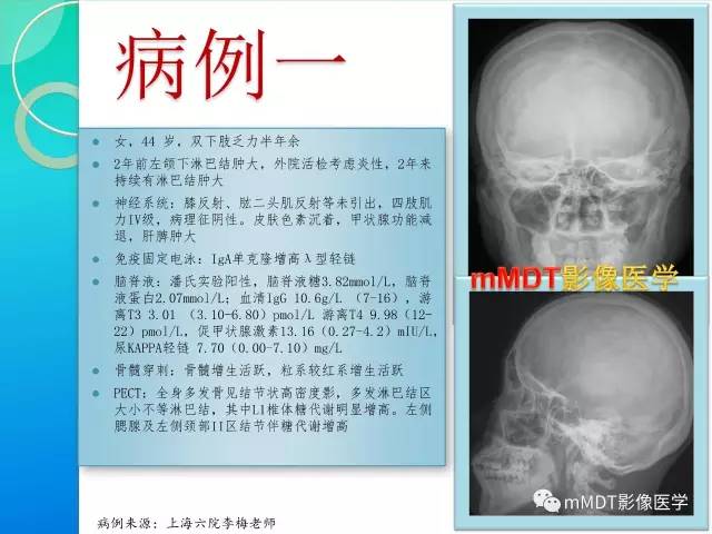 【PPT】POEMS综合征骨改变表现与影像鉴别