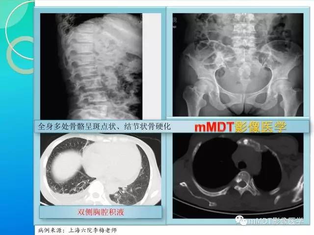 【PPT】POEMS综合征骨改变表现与影像鉴别