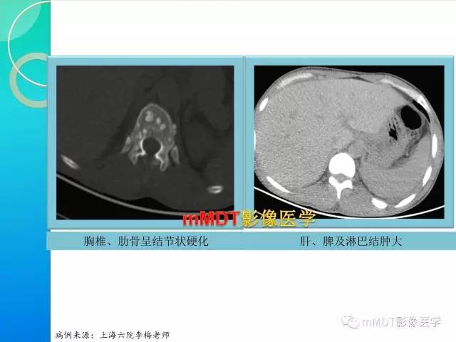 【PPT】POEMS综合征骨改变表现与影像鉴别