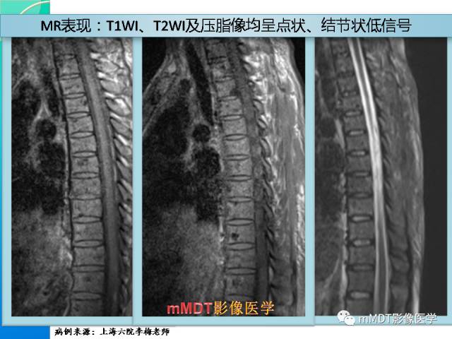 【PPT】POEMS综合征骨改变表现与影像鉴别