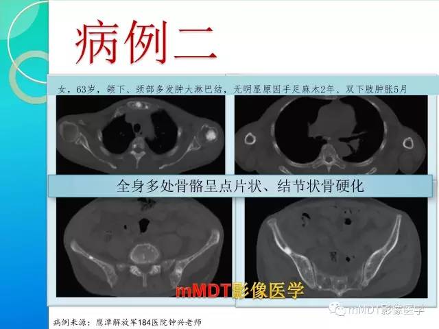 【PPT】POEMS综合征骨改变表现与影像鉴别