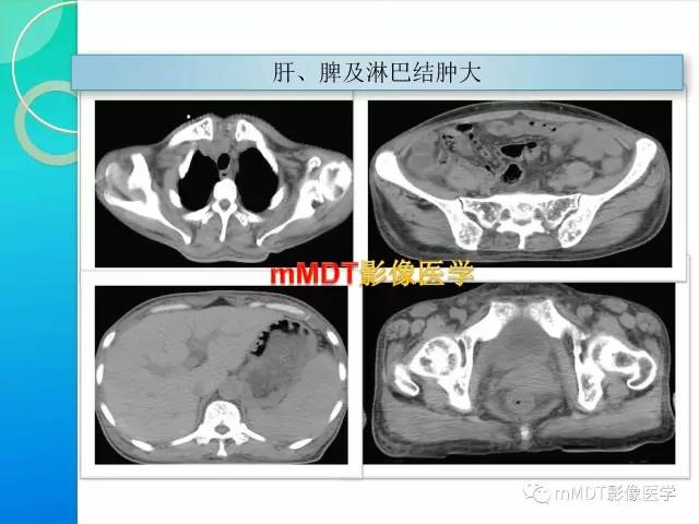 【PPT】POEMS综合征骨改变表现与影像鉴别
