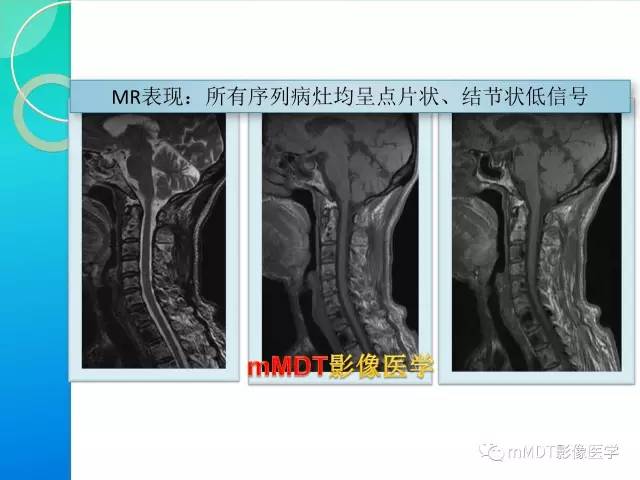 【PPT】POEMS综合征骨改变表现与影像鉴别