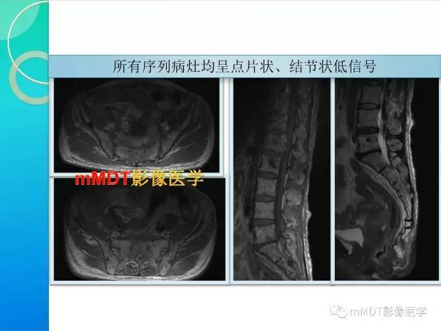 【PPT】POEMS综合征骨改变表现与影像鉴别