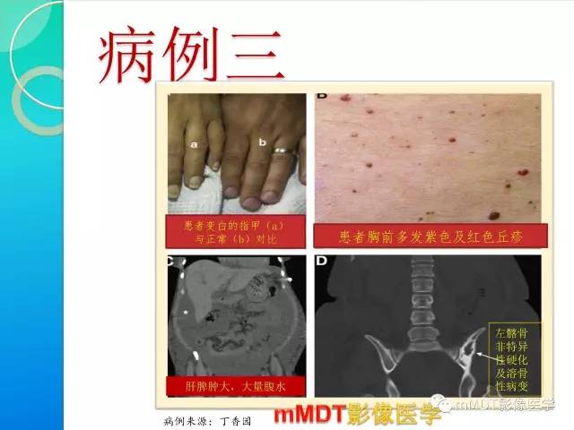 【PPT】POEMS综合征骨改变表现与影像鉴别