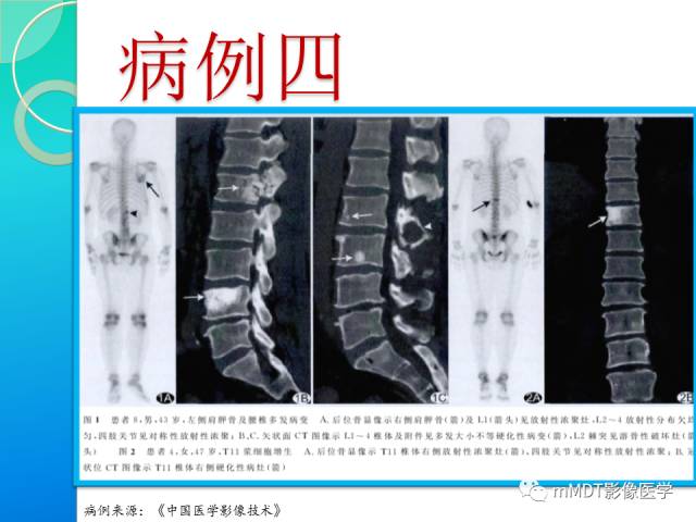 【PPT】POEMS综合征骨改变表现与影像鉴别