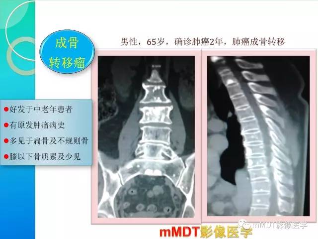 【PPT】POEMS综合征骨改变表现与影像鉴别