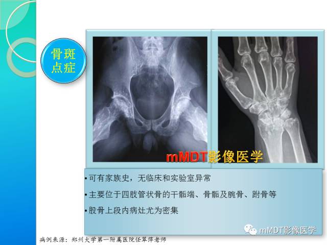 【PPT】POEMS综合征骨改变表现与影像鉴别