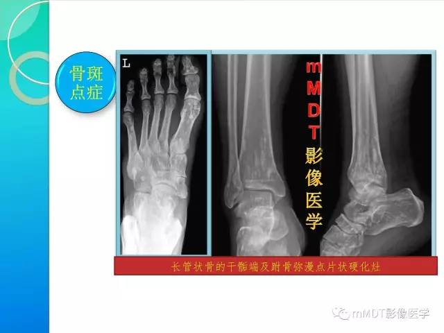 【PPT】POEMS综合征骨改变表现与影像鉴别