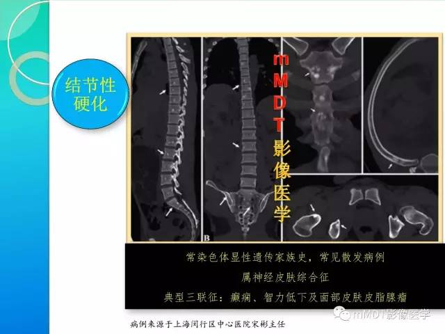 【PPT】POEMS综合征骨改变表现与影像鉴别