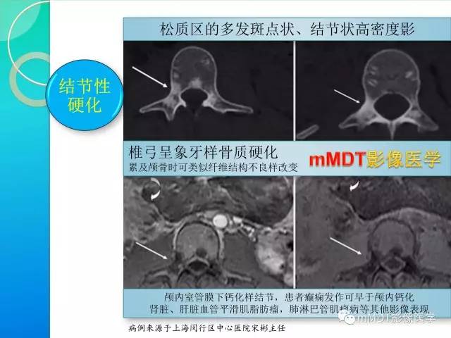 【PPT】POEMS综合征骨改变表现与影像鉴别