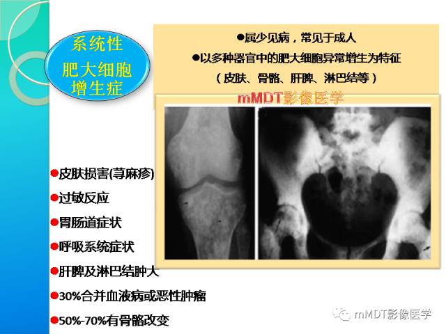 【PPT】POEMS综合征骨改变表现与影像鉴别