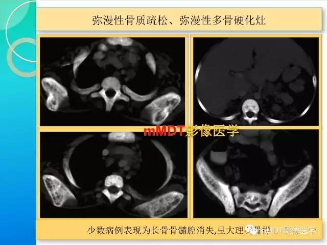 【PPT】POEMS综合征骨改变表现与影像鉴别