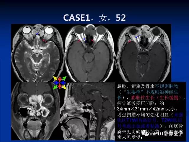 【PPT】头颈部腺样囊性癌的影像学表现