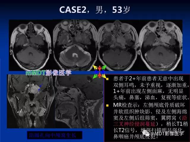 【PPT】头颈部腺样囊性癌的影像学表现