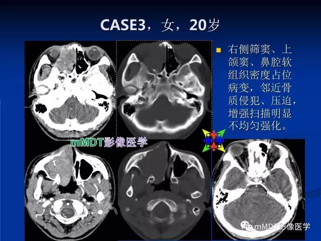 【PPT】头颈部腺样囊性癌的影像学表现