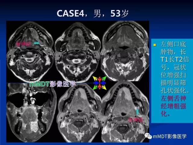 【PPT】头颈部腺样囊性癌的影像学表现