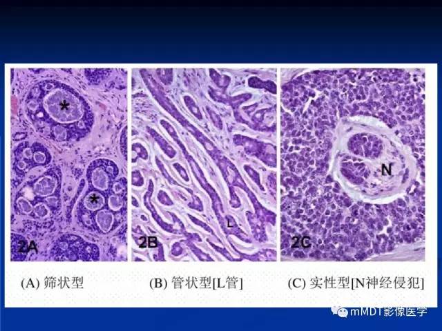 【PPT】头颈部腺样囊性癌的影像学表现