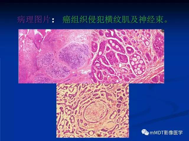 【PPT】头颈部腺样囊性癌的影像学表现