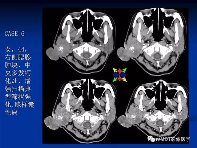 【PPT】头颈部腺样囊性癌的影像学表现