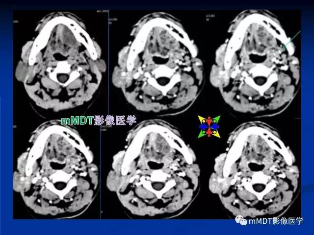 【PPT】头颈部腺样囊性癌的影像学表现