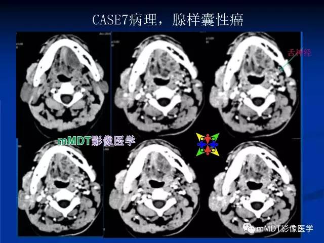 【PPT】头颈部腺样囊性癌的影像学表现