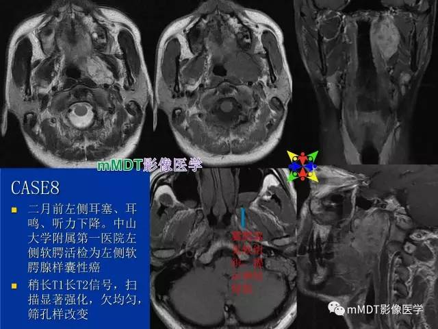 【PPT】头颈部腺样囊性癌的影像学表现