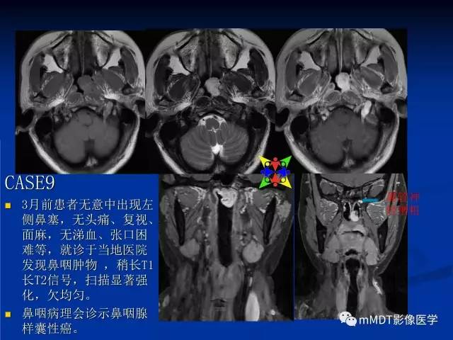 【PPT】头颈部腺样囊性癌的影像学表现