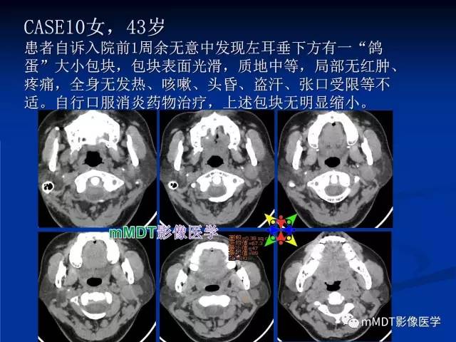 【PPT】头颈部腺样囊性癌的影像学表现