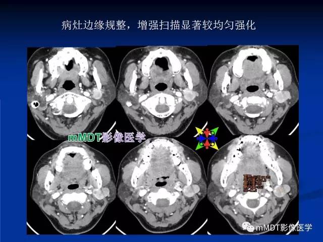 【PPT】头颈部腺样囊性癌的影像学表现
