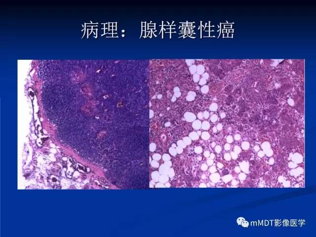 【PPT】头颈部腺样囊性癌的影像学表现