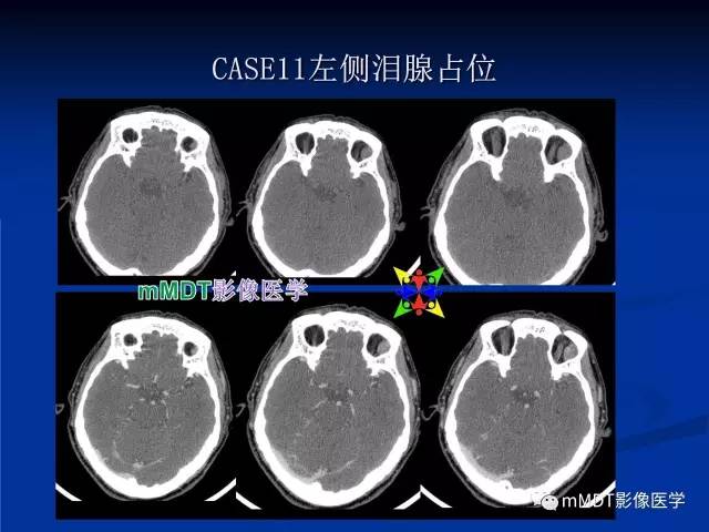 【PPT】头颈部腺样囊性癌的影像学表现