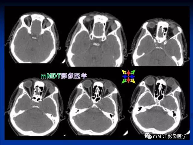 【PPT】头颈部腺样囊性癌的影像学表现