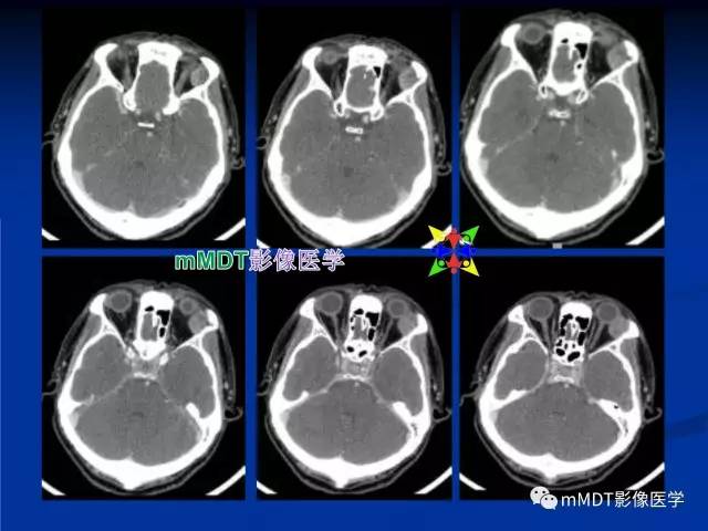 【PPT】头颈部腺样囊性癌的影像学表现