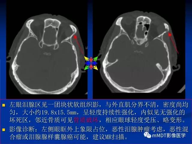 【PPT】头颈部腺样囊性癌的影像学表现