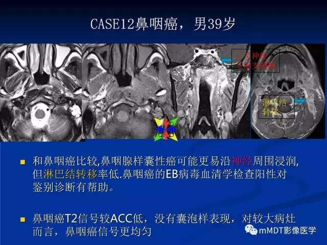 【PPT】头颈部腺样囊性癌的影像学表现