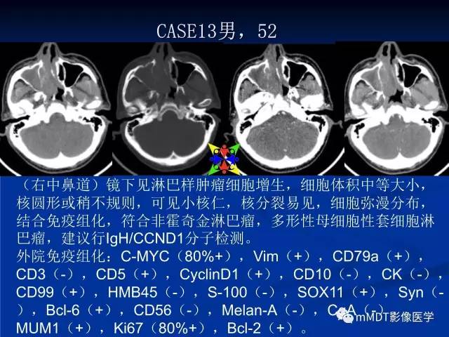 【PPT】头颈部腺样囊性癌的影像学表现