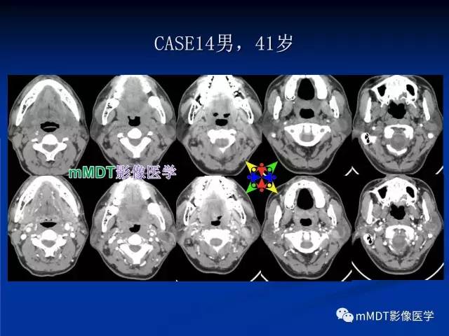 【PPT】头颈部腺样囊性癌的影像学表现
