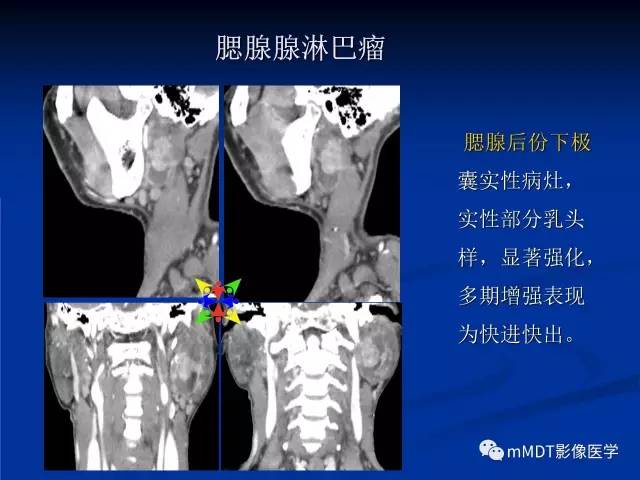 【PPT】头颈部腺样囊性癌的影像学表现