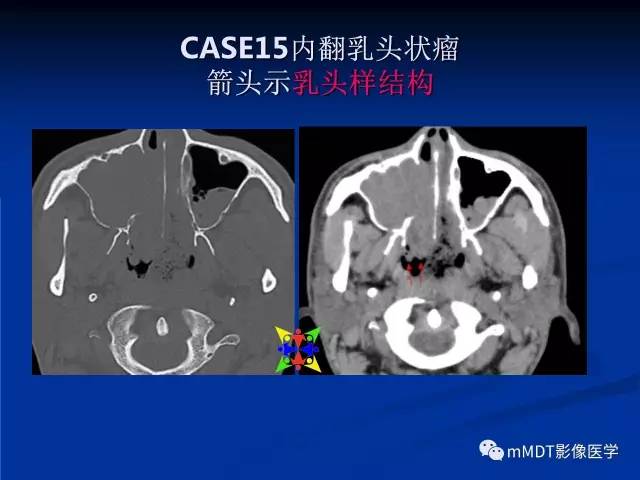 【PPT】头颈部腺样囊性癌的影像学表现