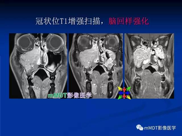 【PPT】头颈部腺样囊性癌的影像学表现