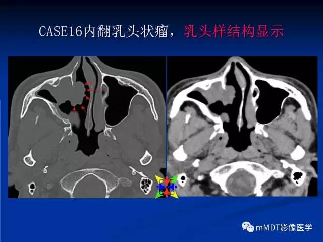 【PPT】头颈部腺样囊性癌的影像学表现