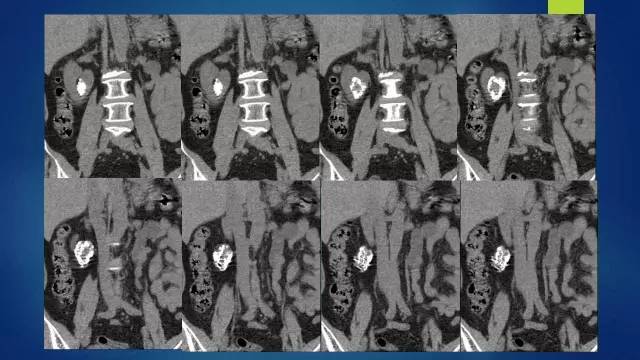 【病例】右肾透明细胞肾细胞癌伴大量钙化1例CT及MR