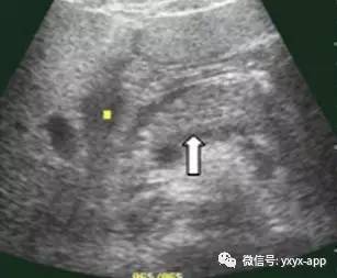 【病例】急性胰腺炎1例超声CT影像表现 【病例】急性胰腺炎1例超声CT影像表现