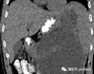 【病例】急性胰腺炎1例超声CT影像表现 【病例】急性胰腺炎1例超声CT影像表现
