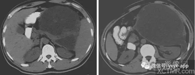 【病例】急性胰腺炎1例超声CT影像表现 【病例】急性胰腺炎1例超声CT影像表现