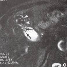 “珍珠项链征”的影像诊断意义 “珍珠项链征”的影像诊断意义