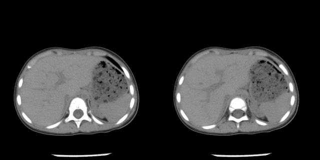 【病例】先天性肾上腺皮质增生症1例CT 【病例】先天性肾上腺皮质增生症1例CT