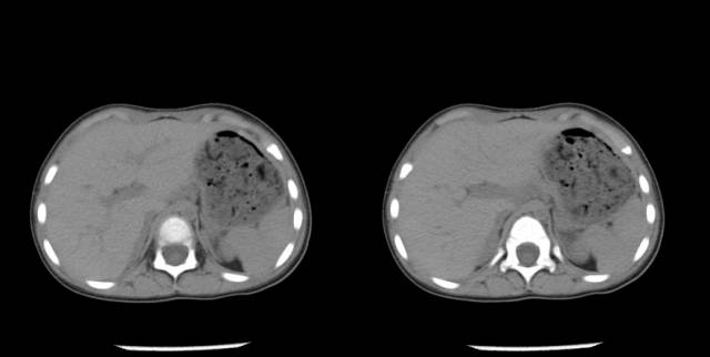 【病例】先天性肾上腺皮质增生症1例CT 【病例】先天性肾上腺皮质增生症1例CT